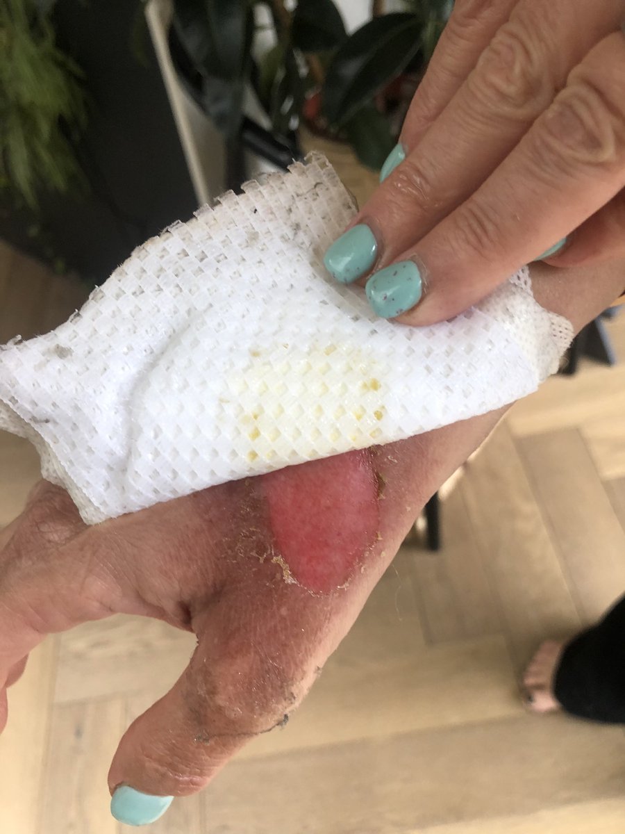 TracyAnnO's tweet photo. Hand update. #Burncollective Medics and Burn people of Twitter .. five days in - is this healing ok? We’ve all been on this journey . X https://t.co/V7QF9Bd5eu