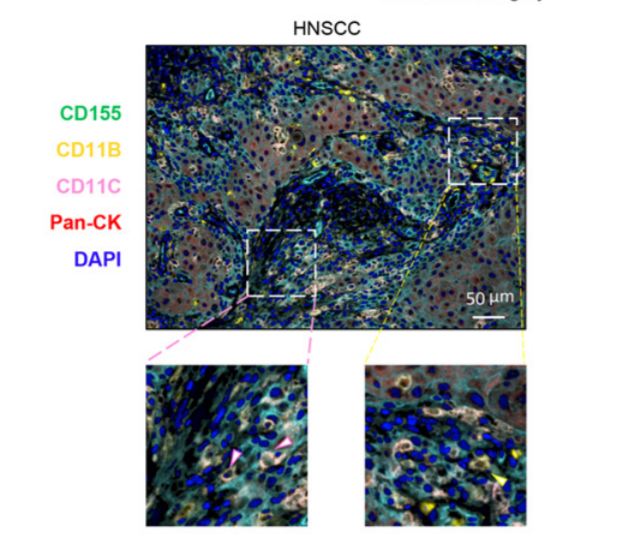 CIR_AACR's tweet photo. See how targeting the #TIGIT/#CD155 #checkpoint signaling pathway can enhance #CD8 #Tcell effector function and #AntitumorResponses in #HNSCC. https://t.co/k3ua5HkvoB
 #Immune2Cancer #CIM20 https://t.co/BDkWc1APUs