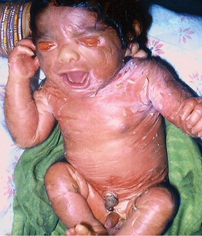Bouteflikov L Ichtyose Harlequin Est Une Maladie Fœtale Rare Les Nouveau Nes Qui En Sont Atteints N Ont Presque Aucune Chance De Survie Apres 1 2 Jours Hors De L Uterus Ils Naissent Avec Bouteflikov L Ichtyose Harlequin Est Une Maladie Fœtale Rare Les Nouveau Nes Qui En Sont Atteints N Ont Presque Aucune Chance De Survie Apres 1 2 Jours Hors De L Uterus Ils Naissent Avec