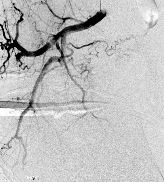 jluka9's tweet photo. PAE #30 200cc prostate with complete urinary retention indwelling Foley. 100-300 Embospheres @MeritMedical. RPA vesical origin. LPA obturator origin #STREAM2020 @SIRspecialists @SIRRFS https://t.co/TWfkVHeh8U