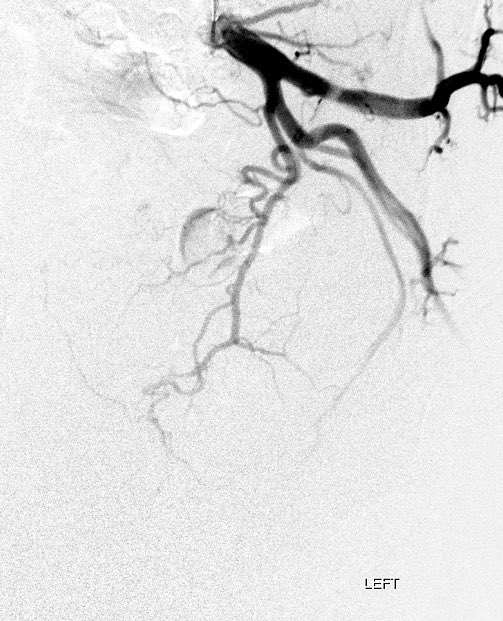 jluka9's tweet photo. PAE #30 200cc prostate with complete urinary retention indwelling Foley. 100-300 Embospheres @MeritMedical. RPA vesical origin. LPA obturator origin #STREAM2020 @SIRspecialists @SIRRFS https://t.co/TWfkVHeh8U