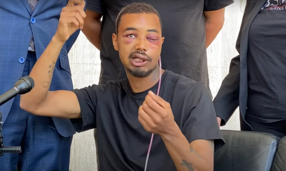 davejourno's tweet image. Brandon Saenz, 26, was shot in the left eye by @DallasPD Saturday night by a rubber bullet. He lost the eye, several teeth &amp;amp; had facial fractures that required several surgeries. His presser just wrapped, is demanding action from @ChiefHallDPD. Story forthcoming @CourthouseNews