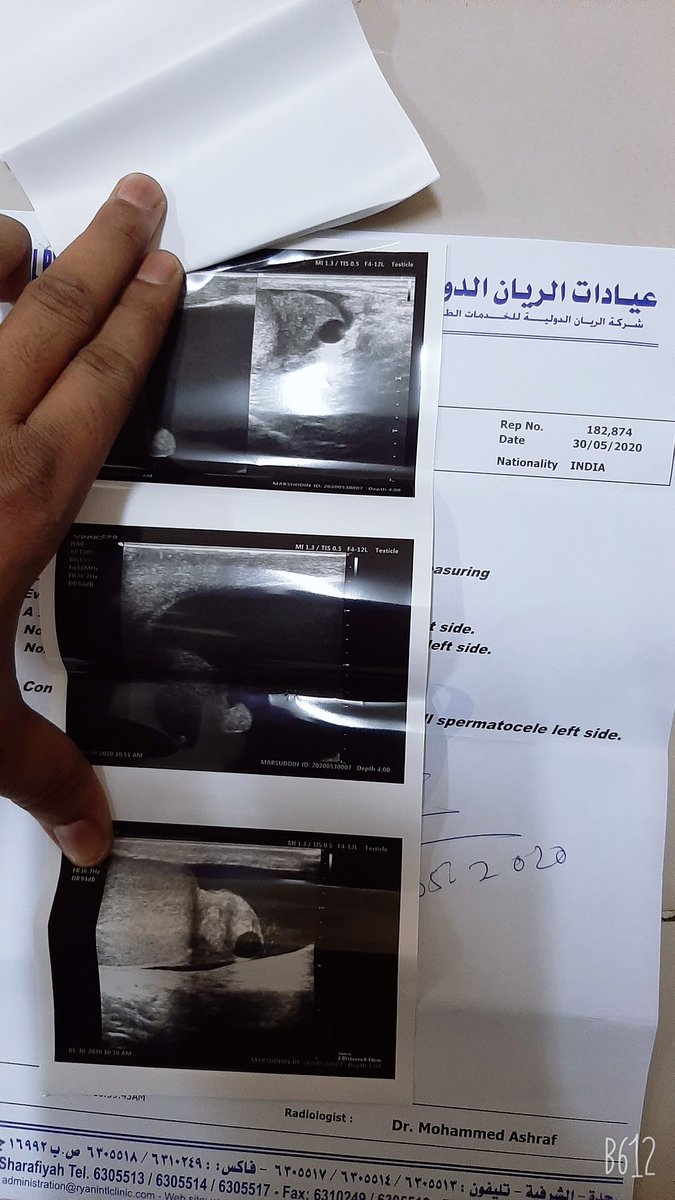MursuddinA's tweet photo. @drausaf Sar ji company ne bola report Lekar Aao main exit Laga Dunga main report Lekar Gaya bolate Hain yah report Nahin chalegi Mujhe operation Karana hydrosil ka main bahut Pareshan hun please Sar help kariye kam Bhi Nahin Hai room mein Baitha hun Jeddah mein hun https://t.co/5nbG0lG0n8