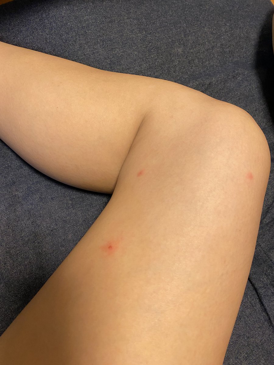 松島 蘭 V Twitter 私の内腿に 夏の大三角形が現れました 夏ですね 他にも4箇所刺された 痒い この歳になると痕に残る 消えない傷跡 O型刺されやすい説