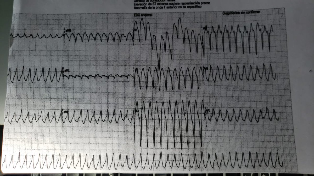 GusCostaEP's tweet image. 3 y.o.m, without cardiac disease, well tolerated. (Sorry about tracing). Diagnosis?