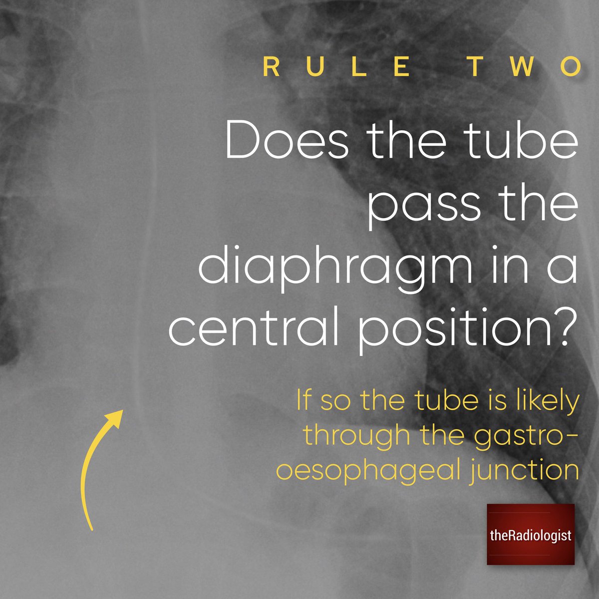 radiologistpage's tweet photo. Confirming NG tube placement on Chest X-Ray

Four basic rules for those not familiar https://t.co/2aNrpHjuag