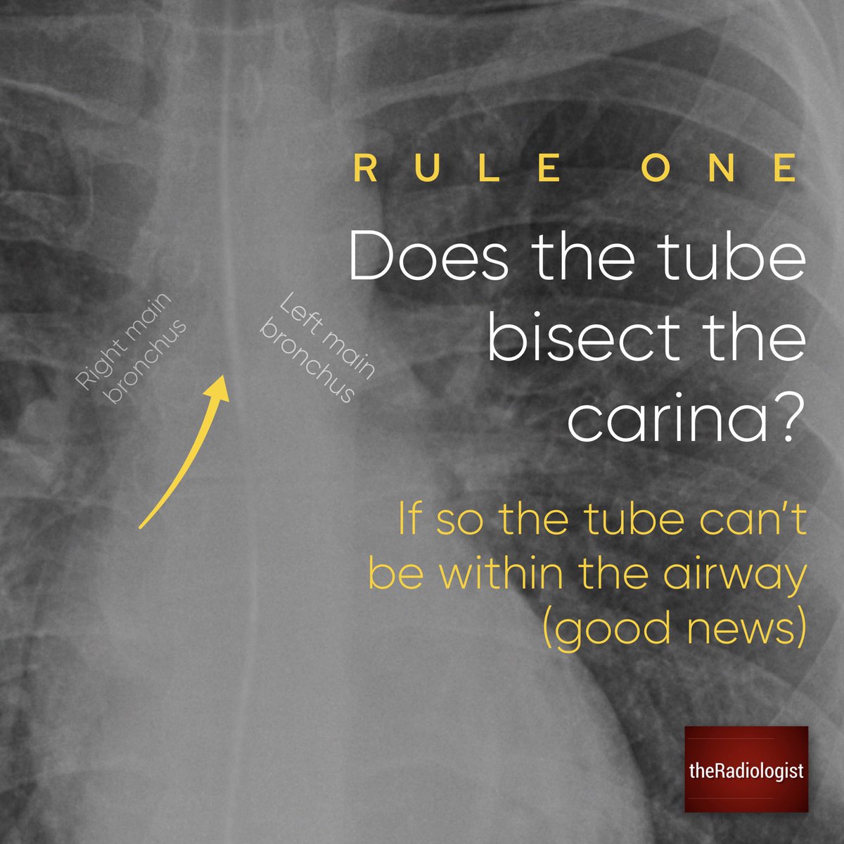 radiologistpage's tweet photo. Confirming NG tube placement on Chest X-Ray

Four basic rules for those not familiar https://t.co/2aNrpHjuag