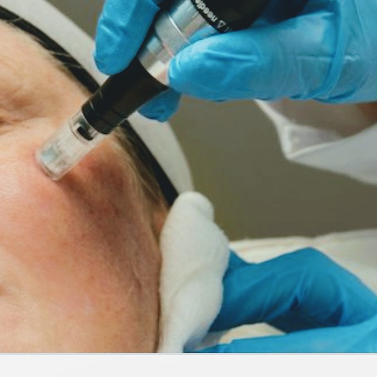 facialsbyceci's tweet photo. ๐Have acne scars, fine lines or uneven skin texture and tone? ๐ Microneedling with PRP
Introductory price of $220
Free consultation 305- 951-1539
#Microneedling
#MicroneedlingWithPRP
#SkinResurfacing
#SkinRejuvenation https://t.co/PAbUouXmoO