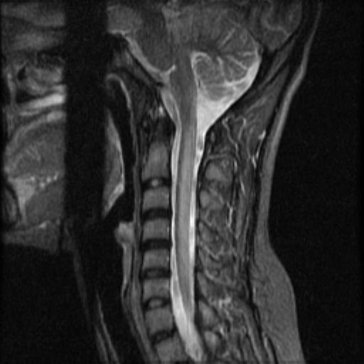 thexraydoctor's tweet photo. Here is a case by Dr Nafisa Shakir Batta showing oedema of the dorsal columns, with an "inverted V" sign on the axial imaging.
The whole case is on @Radiopaedia 👉🏼 https://t.co/pj9ei980Y7
2/4
#FOAMrad #VitaminWeek #B12 https://t.co/CQgVDPnhxY