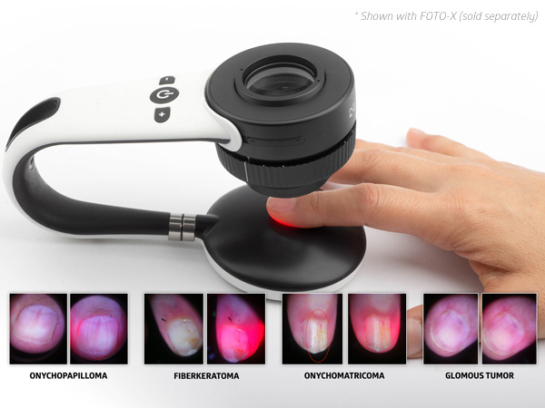 New @DermLite Product! - Nailio: a special Foto X attachment that not only allows for ideal imaging of the nail, but also adds a unique red light that allows important vascular features to be visualised.
docstock.com.au/default.asp?Pr…