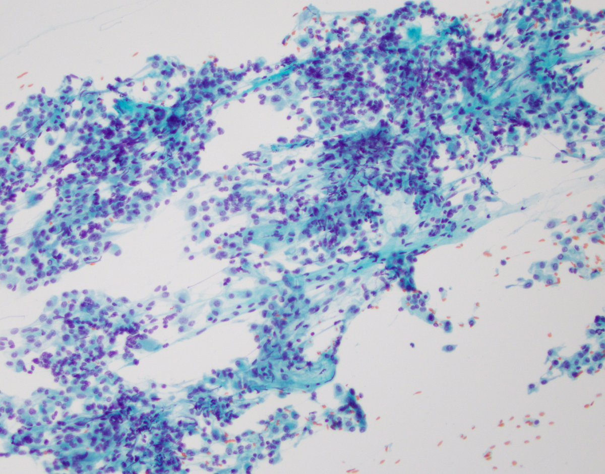 FNA clear cell renal cell carcinoma: Cells w abundant cytoplasm and w small cytoplasmic vacuoles. Can be difficult on liquid based preps where the cells r bland &amp; may mimic histiocytes (low N:C, eccentric nuclei). The smears r helpful, w large vascular cohesive groups #cytopath