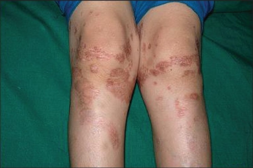 Imagen: Las piernas de un niño con parches de piel apretada y endurecida causada por la esclerodermia.