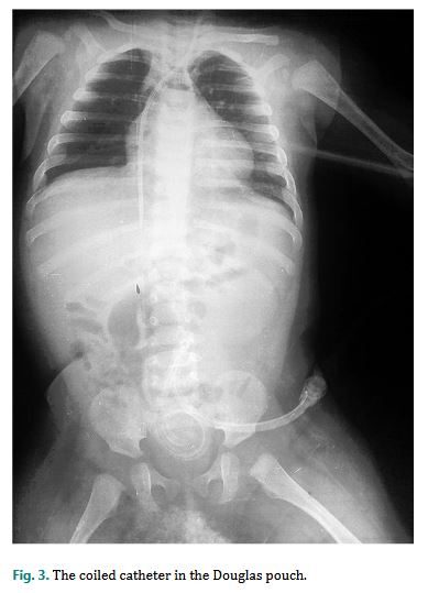 NephroKarger's tweet photo. Catheter Access Management for Acute Peritoneal Dialysis
✍️ Mohamed Amine Rahil
✍️ Achour Bouzgueg
📄 https://t.co/5g1QjvMEQf
#CaseRepNephrolDial #OpenAccess #PeritonealDialysis #catheter https://t.co/ymiAGgjWiS