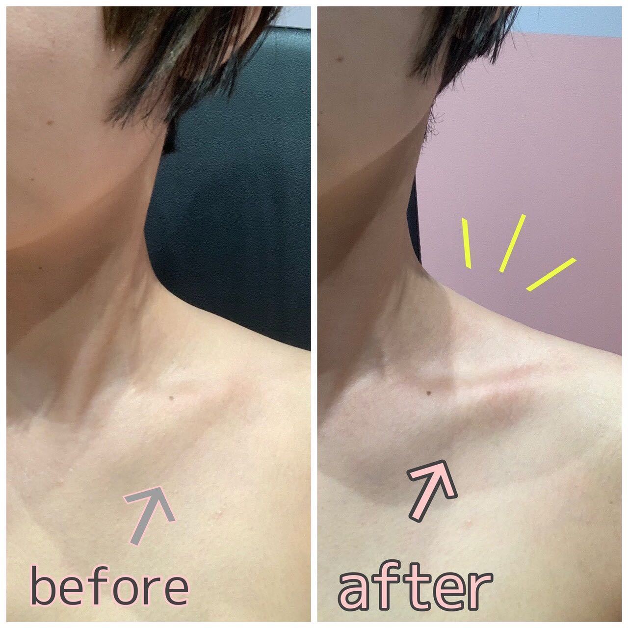 定額制セルフエステ Body Archi ボディアーキ 公式 デコルテの ビフォーアフター モノポーラ マルチポーラ フェイシャル Ems ポレーション フェイシャルを各5分ずつかけた結果 むくみが取れて鎖骨がくっきり 首周りにマシンをかけることで顔