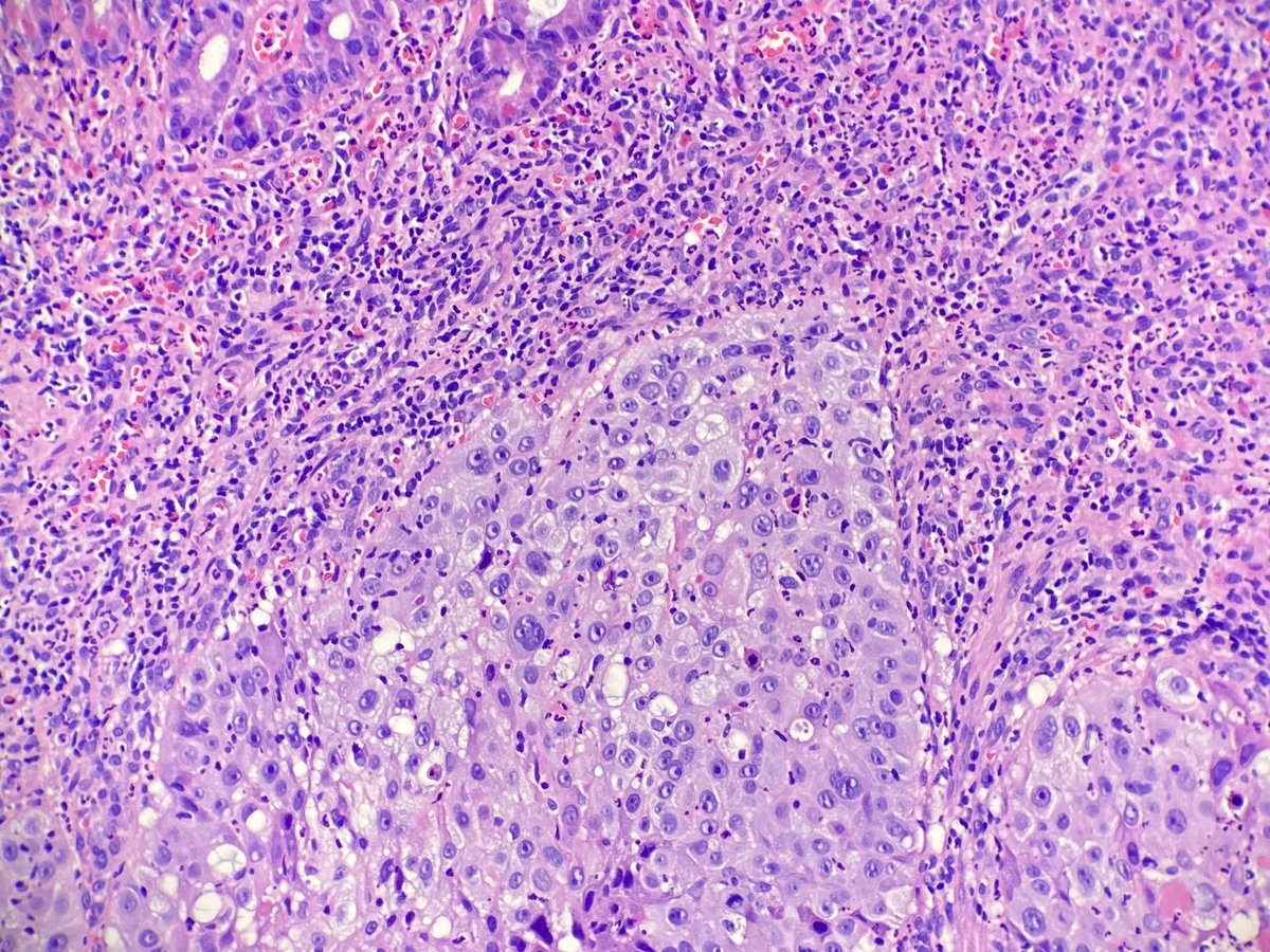 NRiddleMD's tweet photo. Duodenal biopsy, can you guess where the met is from? I'll be nice and give some demographics 😜 47 yof https://t.co/I1IIEdTqGY