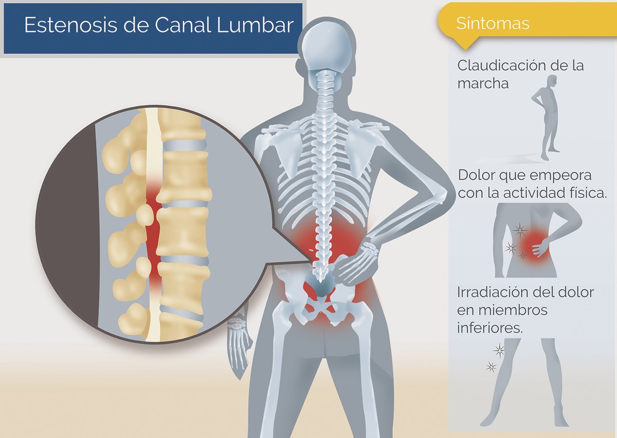 Equipo De la Torre on X: #Infografía Sentir hormigueo y debilidad