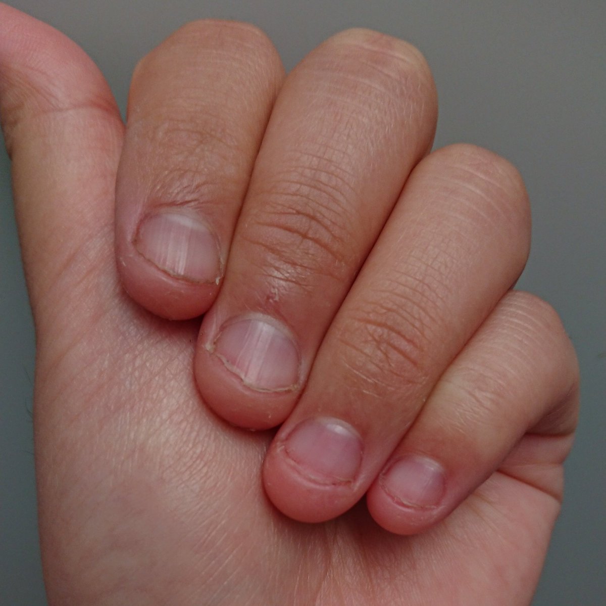 爪噛み克服女子 22 去年の9月からこの垢を使って9ヶ月目です この9ヶ月の間何回も何回も爪をかみ続け て 今も気になってる 自分の気持ちが弱いのは分かってるけど ここまで伸びたのはほんとに頑張ったって思った 自画自賛