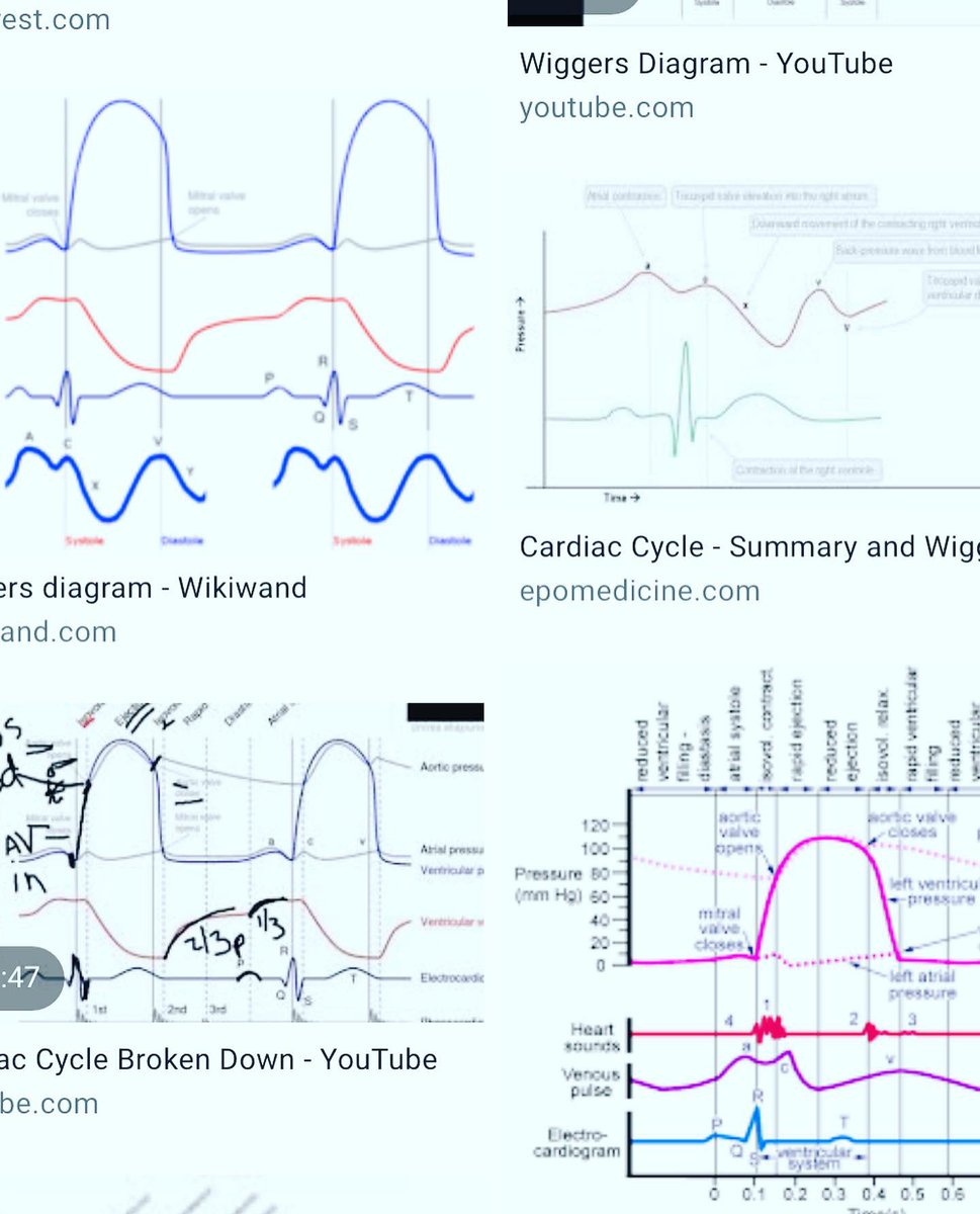 Cardiac Physiology.
Start with a few waves. LV, AO, and PCWP.
Green mitral closes. Blue AO opens. Blue AO closes. Green mitral opens.
Start with learning those few facts and then add on.
#wiggersdiagram #cardiacphysiology
#juststart