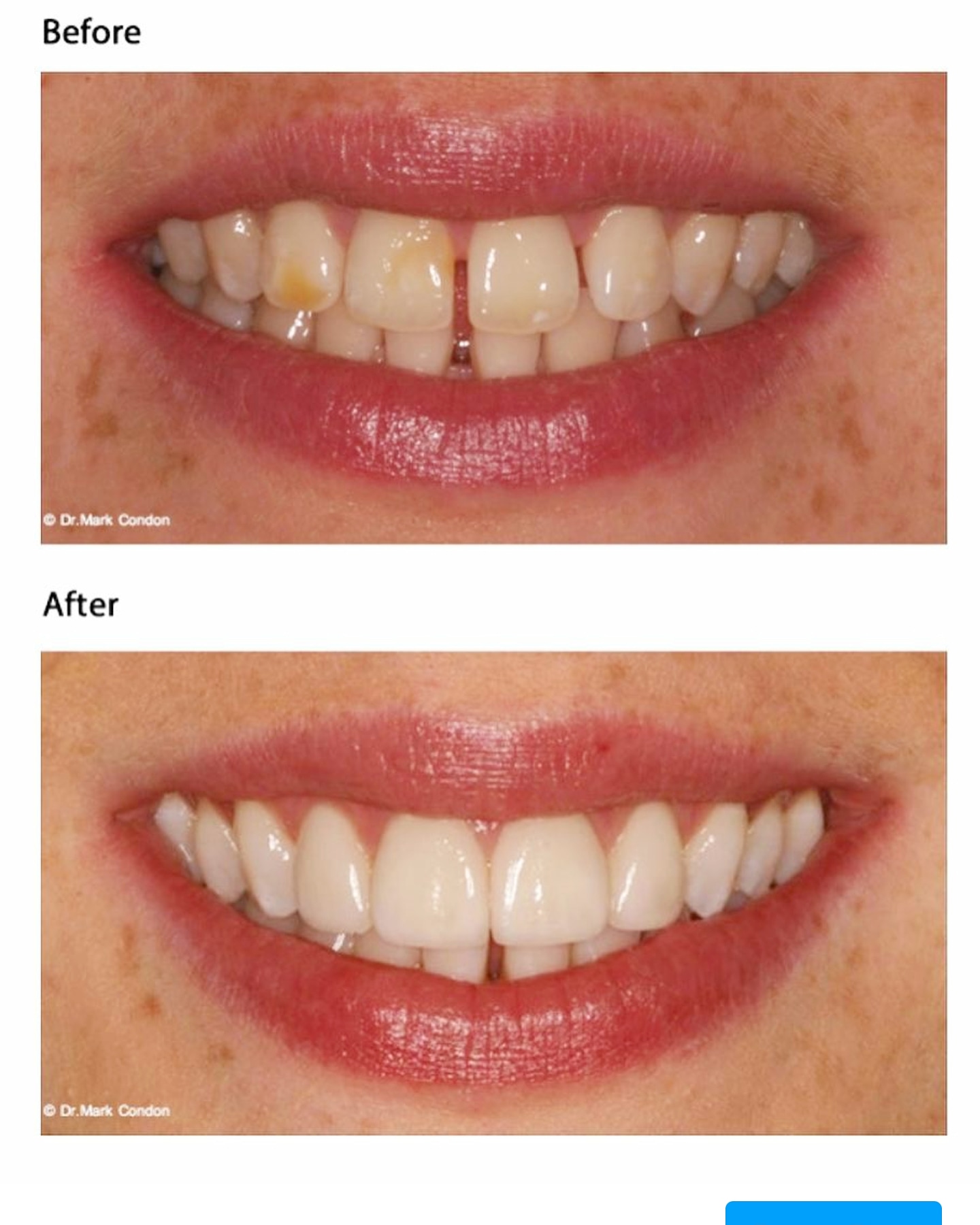 Dr EllenGene Long on Twitter "Myth No 3 " Veneers make you look like