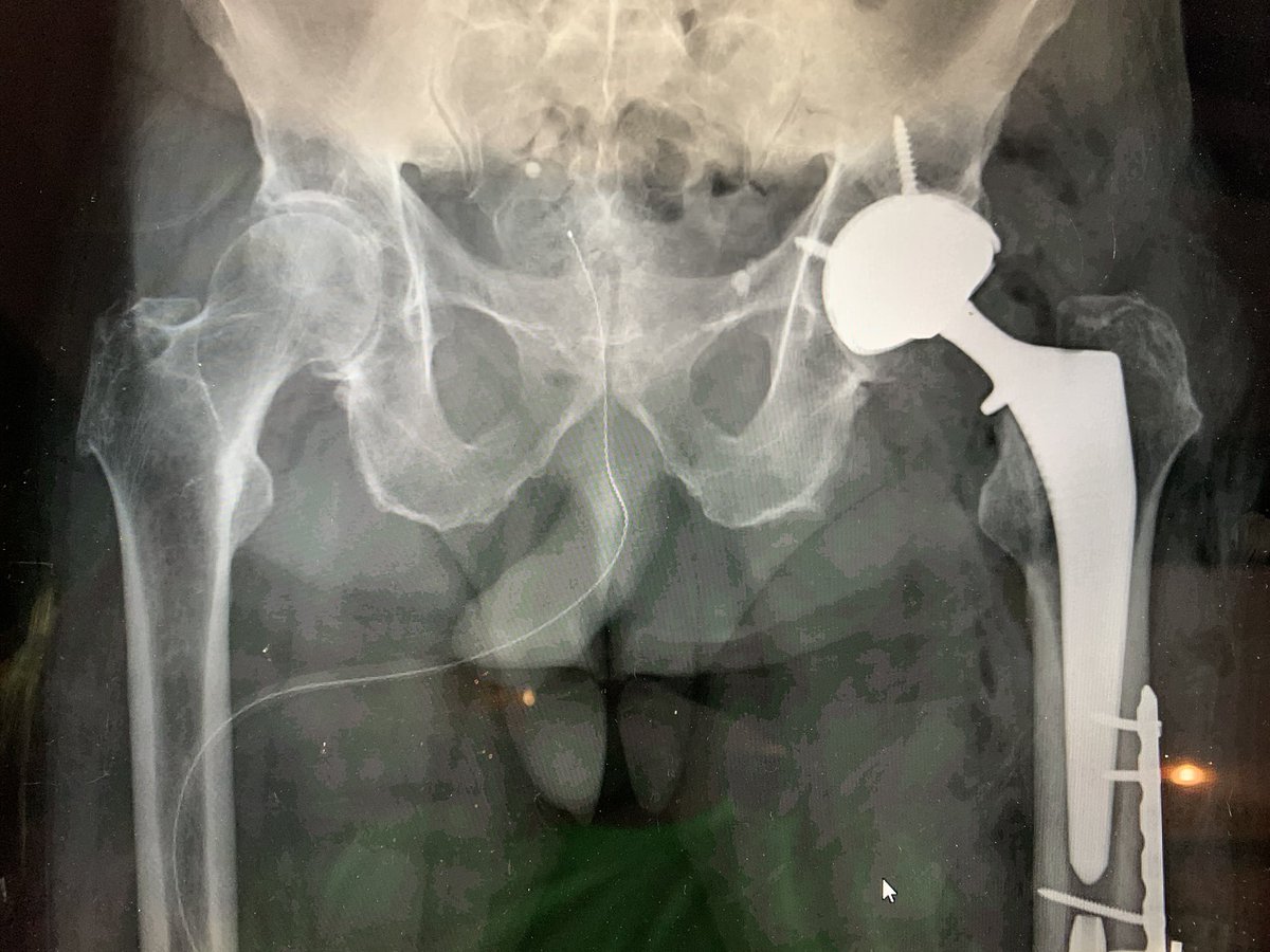Interesting educational case : 🧵 
#orthotwitter 
Active older patient, trauma. 

Segmental open femu...