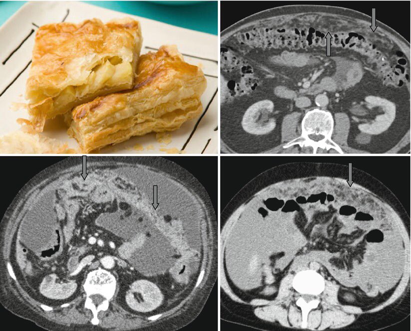 what is stage 4 primary peritoneal cancer