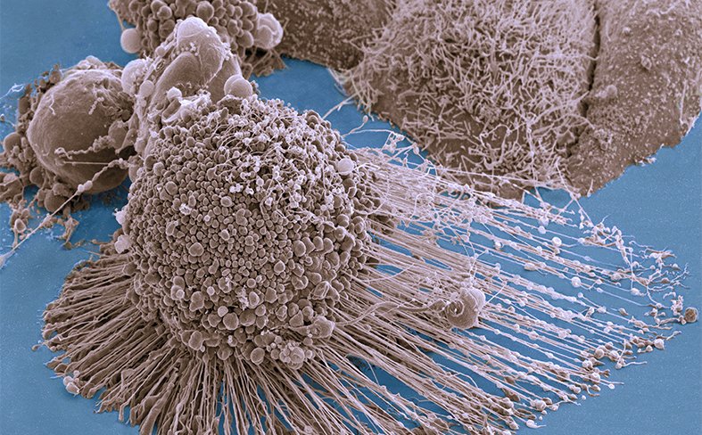 Donnelly Centre (@donnellycentre) on Twitter photo When cancer cells can't make their own fat, they eat more of it, new Donnelly Centre study has found.
The findings, from Moffat, Andrews & Boone labs <a href="/DonnellyCentre/">Donnelly Centre</a> with the Myers team <a href="/UMNComputerSci/">UMN Computer Science & Engineering</a>, could be exploited for therapy.
bit.ly/MetabolismSwit… When cancer cells can't make their own fat, they eat more of it, new Donnelly Centre study has found.
The findings, from Moffat, Andrews & Boone labs <a href="/DonnellyCentre/">Donnelly Centre</a> with the Myers team <a href="/UMNComputerSci/">UMN Computer Science & Engineering</a>, could be exploited for therapy.
bit.ly/MetabolismSwit…