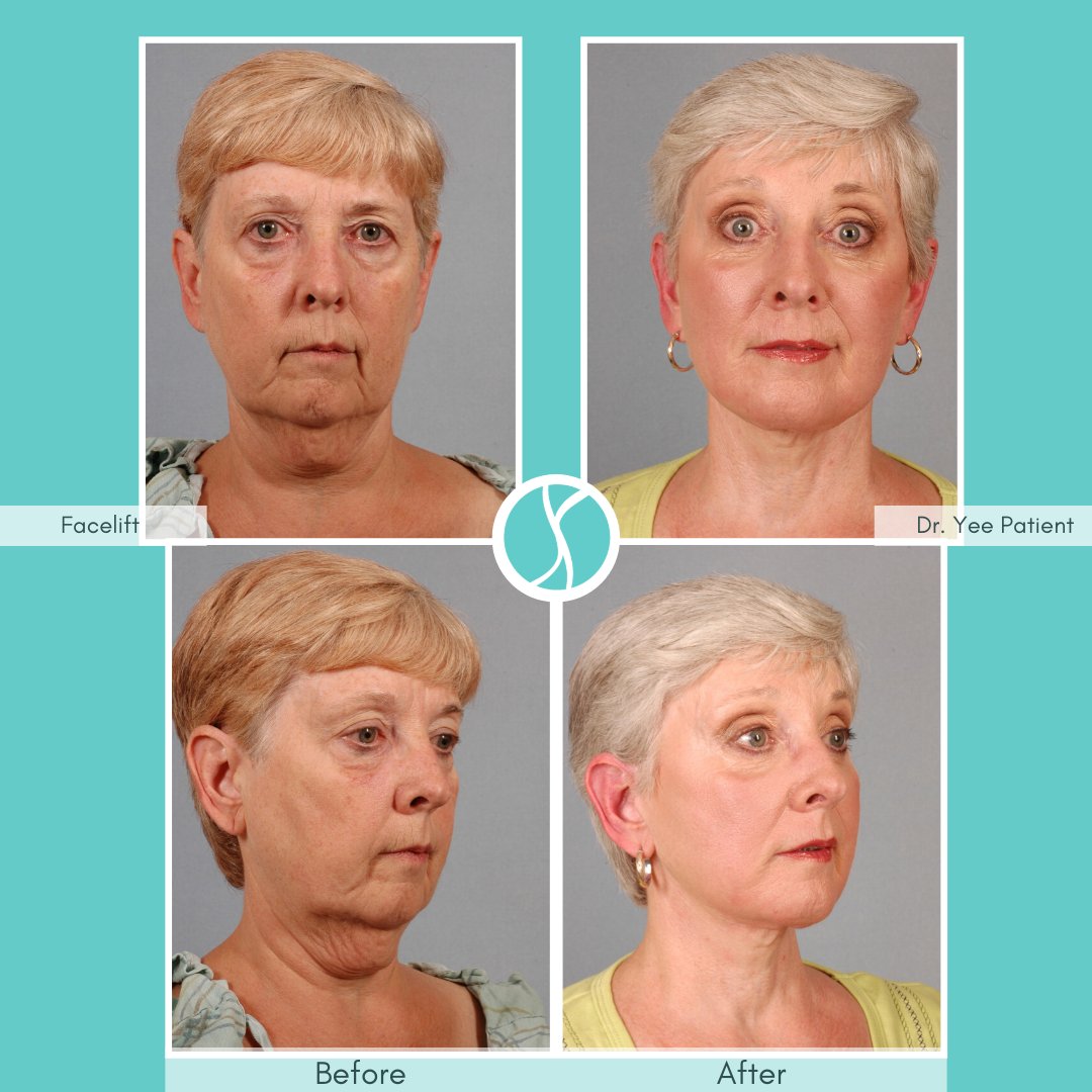 DrSuzanneYee's tweet photo. 🗣 #FaceliftFriday 💜 This lovely woman has amazing results! She looks rejuvenated, while still looking natural. Call our office for more information!📲 501.224.1044
#dryee #dryeeme #littlerock #arkansas #PatientSafety #CosmeticSurgery #medspa #aacswomen https://t.co/OLy8yhtUek