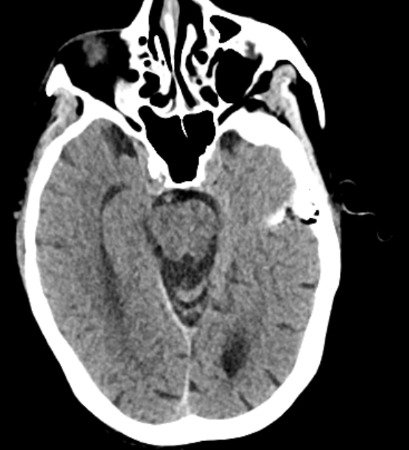mdneurorads's tweet photo. Case #14
S/p blunt trauma with skull and mid face fxs. Can you spot the subtle acute finding?
Scrollable DICOM study via @pacsbin
CT: https://t.co/Y8AY7K8WhI
Answer tomorrow!
#Radres #Neuroradiology #FOAMrad #FOAMed #NeuroRad #radiology #Radfellow #HNrad #Traumarad #MedTwitter https://t.co/U5gsiWt4ru