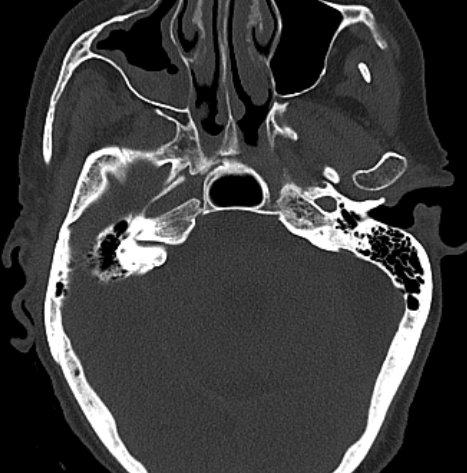 mdneurorads's tweet photo. Case #14
S/p blunt trauma with skull and mid face fxs. Can you spot the subtle acute finding?
Scrollable DICOM study via @pacsbin
CT: https://t.co/Y8AY7K8WhI
Answer tomorrow!
#Radres #Neuroradiology #FOAMrad #FOAMed #NeuroRad #radiology #Radfellow #HNrad #Traumarad #MedTwitter https://t.co/U5gsiWt4ru