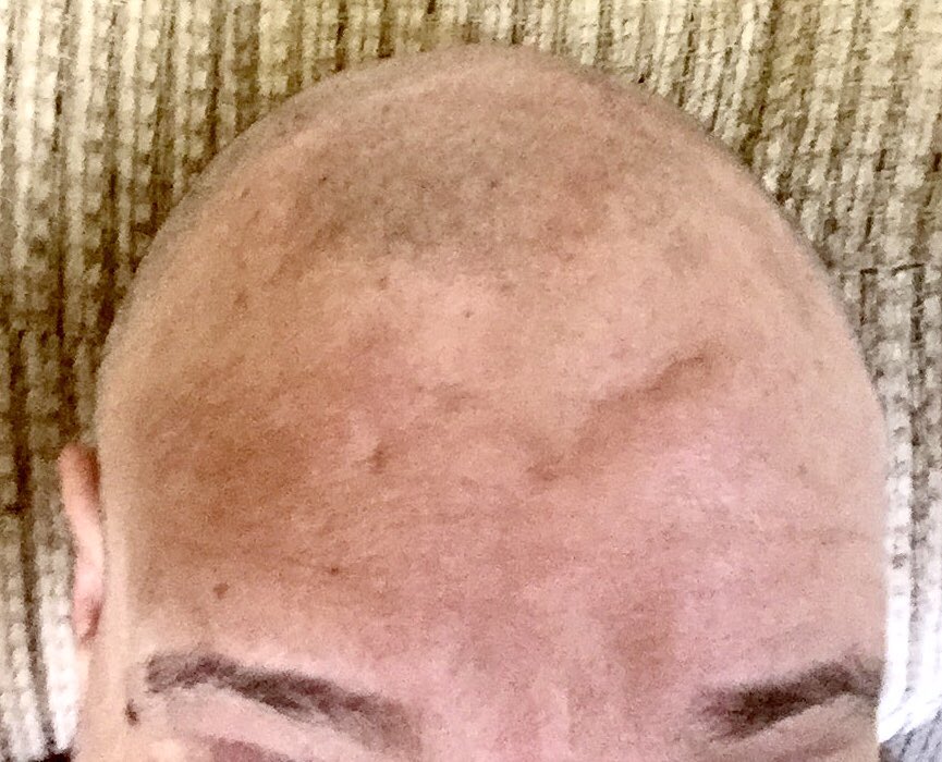 MrWiseGuy2U's tweet photo. I did not deliberately #GoBaldForBLM The timing was purely coincidental. I actually did it because the salons here won’t open for at least another 3 weeks, and nobody was supposed to see me for about a month.

Since I’m already bald can I just hop on the bandwagon proactively⁉️ https://t.co/aZT3UKsDV5