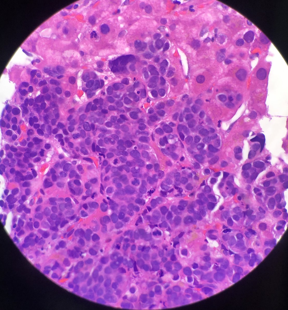 essel_eda's tweet photo. Liver and Lung masses in 80 yo male, CK7 +, negative for CK20, TTF1, Chromo, synapto, GAtA-3 and few more, any thoughts? Liver Bx #patholog #PathTwitter #GIpath @CArnold_GI @DrGeeONE @thoracicpath https://t.co/zcvgp3hG6e