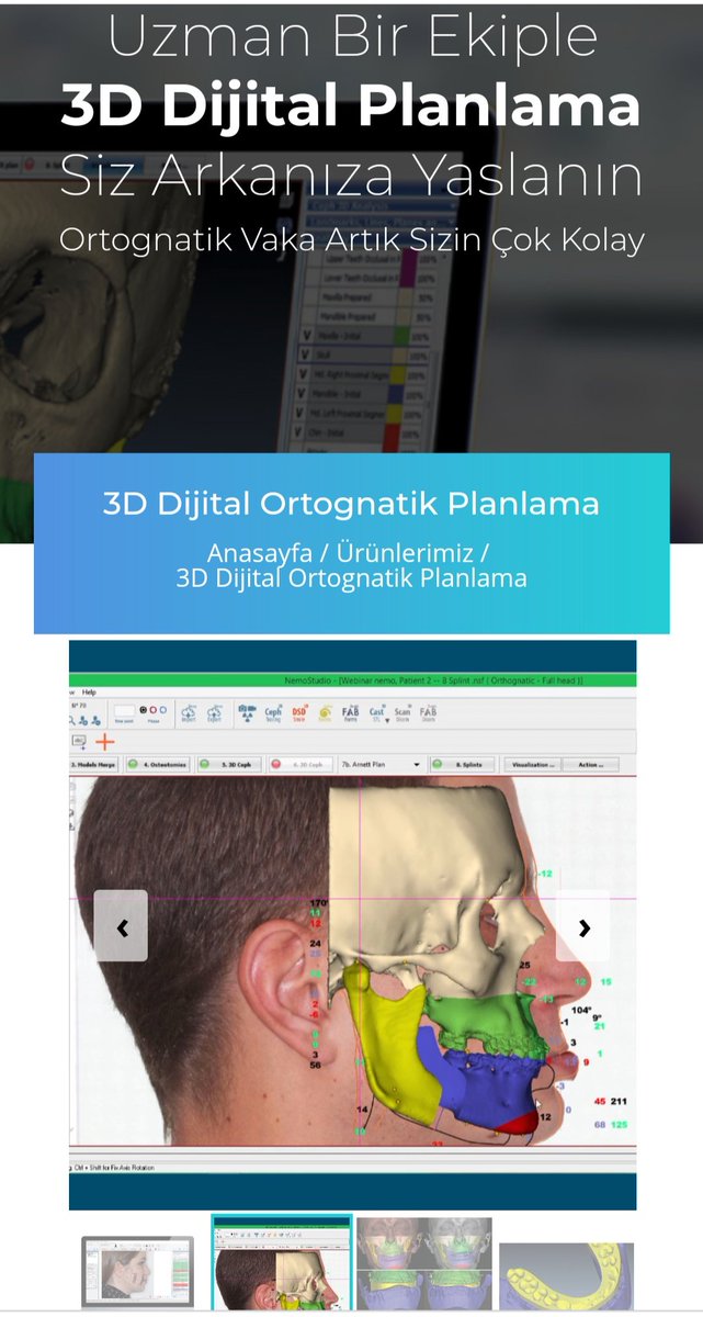 3D Digital orthognathic surgery planning
#ortognatikcerrahi #çenecerrahisi  #orthognathicsurgery #nemotec #nemofab #dolphin3dsurgery #dolphinimaging #cephalometrics #yüzestetikcerrahisi #facialesthetics #ortodonti #digitalorthodontics #dijitalortodonti #virtualplanning #OrthoDigi