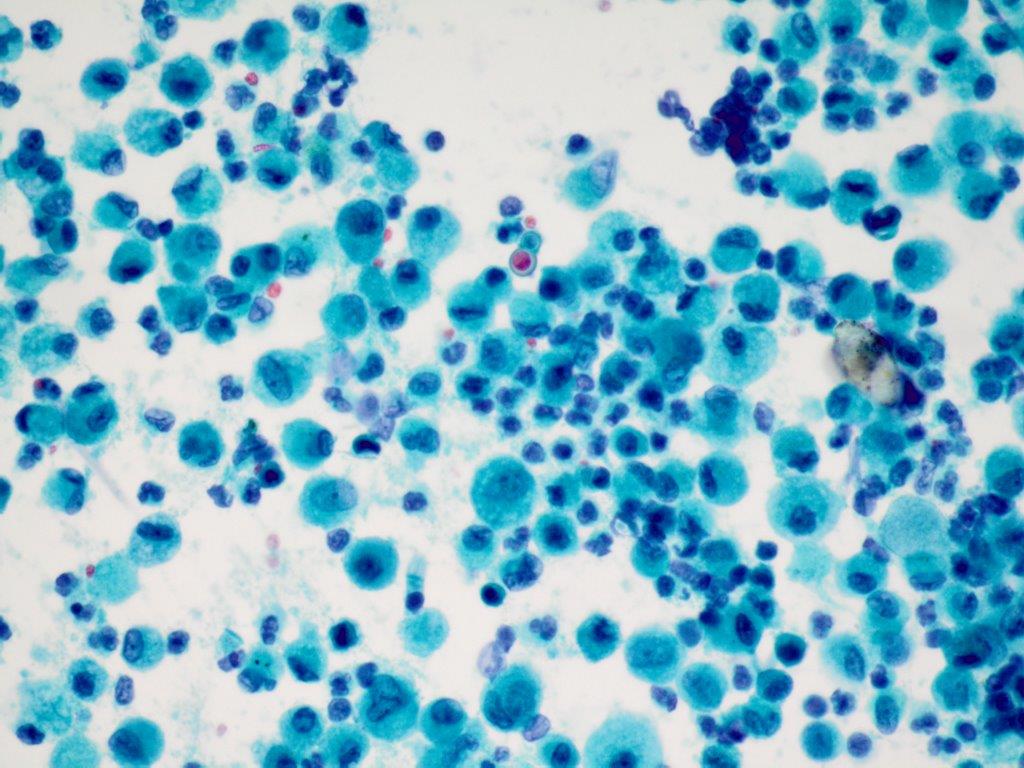israhkhan's tweet photo. Blastomyces in a BAL. Rare broad based budding yeast hidden in alveolar macrophages. Can be easily missed if not carefully screened. Concurrent TBBx with granuloma and a budding yeast. Positive silver stain https://t.co/059Dx5WBIG