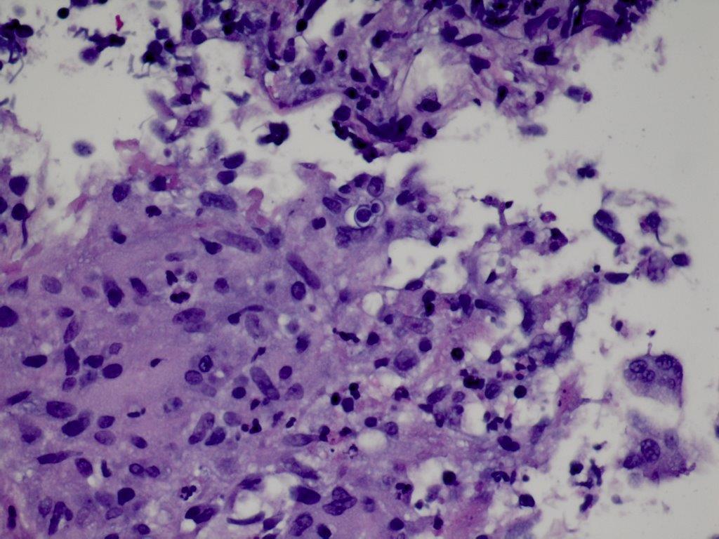 israhkhan's tweet photo. Blastomyces in a BAL. Rare broad based budding yeast hidden in alveolar macrophages. Can be easily missed if not carefully screened. Concurrent TBBx with granuloma and a budding yeast. Positive silver stain https://t.co/059Dx5WBIG