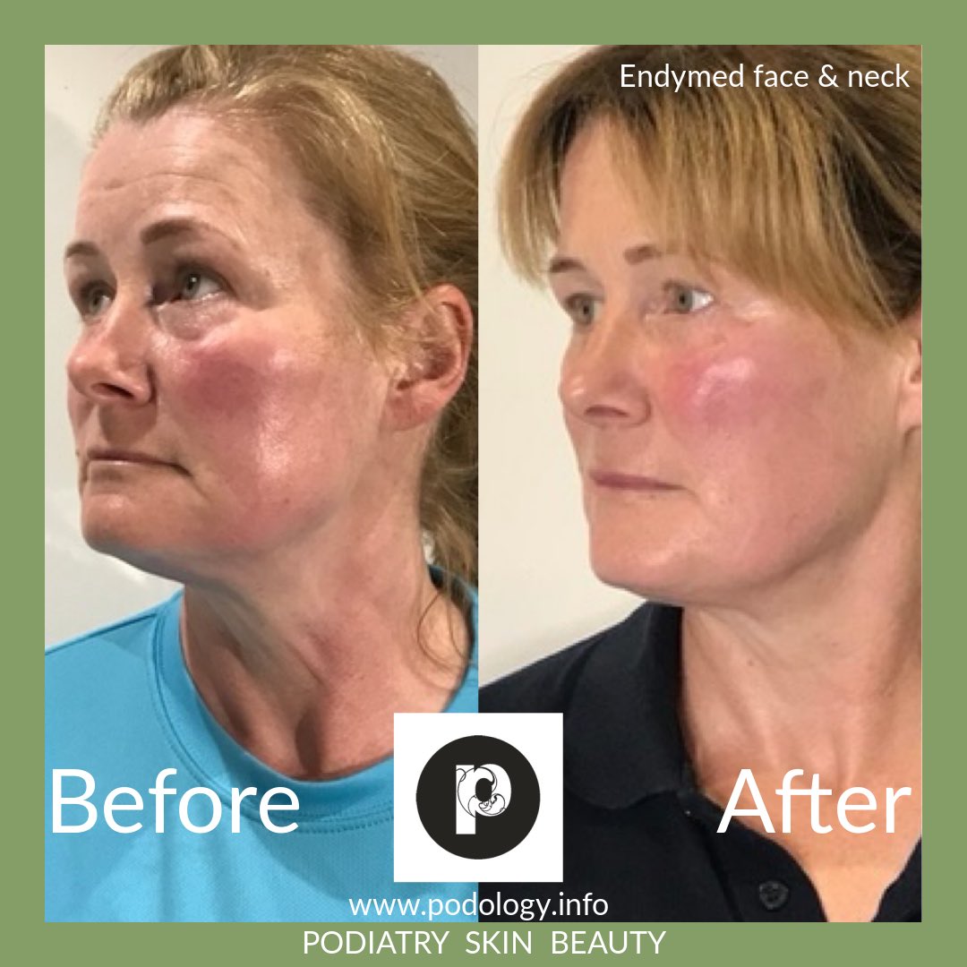 Podology (@podology) on Twitter photo Wow what a transformation for Jean using <a href="/EndyMed/">ENDYMED Medical</a> tighten for face and neck. You look amazing Jean ❤️
#endymed #podology #podologysaltburn #saltburn Wow what a transformation for Jean using <a href="/EndyMed/">ENDYMED Medical</a> tighten for face and neck. You look amazing Jean ❤️
#endymed #podology #podologysaltburn #saltburn