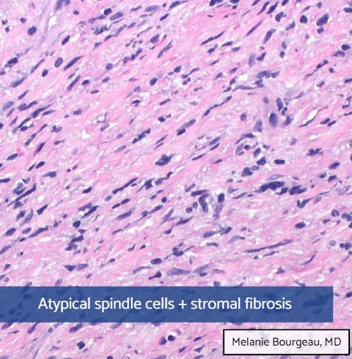 GAPathologists's tweet photo. Correct answer: D
β³οΈ This is a case of spindle DLBCL involving the vagina
β³οΈ Rare; most cases in skin
β³οΈ Majority GCB phenotype
β³οΈ Rapid growth, but good response to treatment
Learn more in this month's GAP News π°
β‘οΈ https://t.co/Wn70IOts0Y β¬
οΈ
#GAPCoTM #hemepath #gynpath https://t.co/UdwV8YJqNU