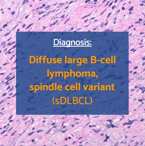 GAPathologists's tweet photo. Correct answer: D
β³οΈ This is a case of spindle DLBCL involving the vagina
β³οΈ Rare; most cases in skin
β³οΈ Majority GCB phenotype
β³οΈ Rapid growth, but good response to treatment
Learn more in this month's GAP News π°
β‘οΈ https://t.co/Wn70IOts0Y β¬
οΈ
#GAPCoTM #hemepath #gynpath https://t.co/UdwV8YJqNU