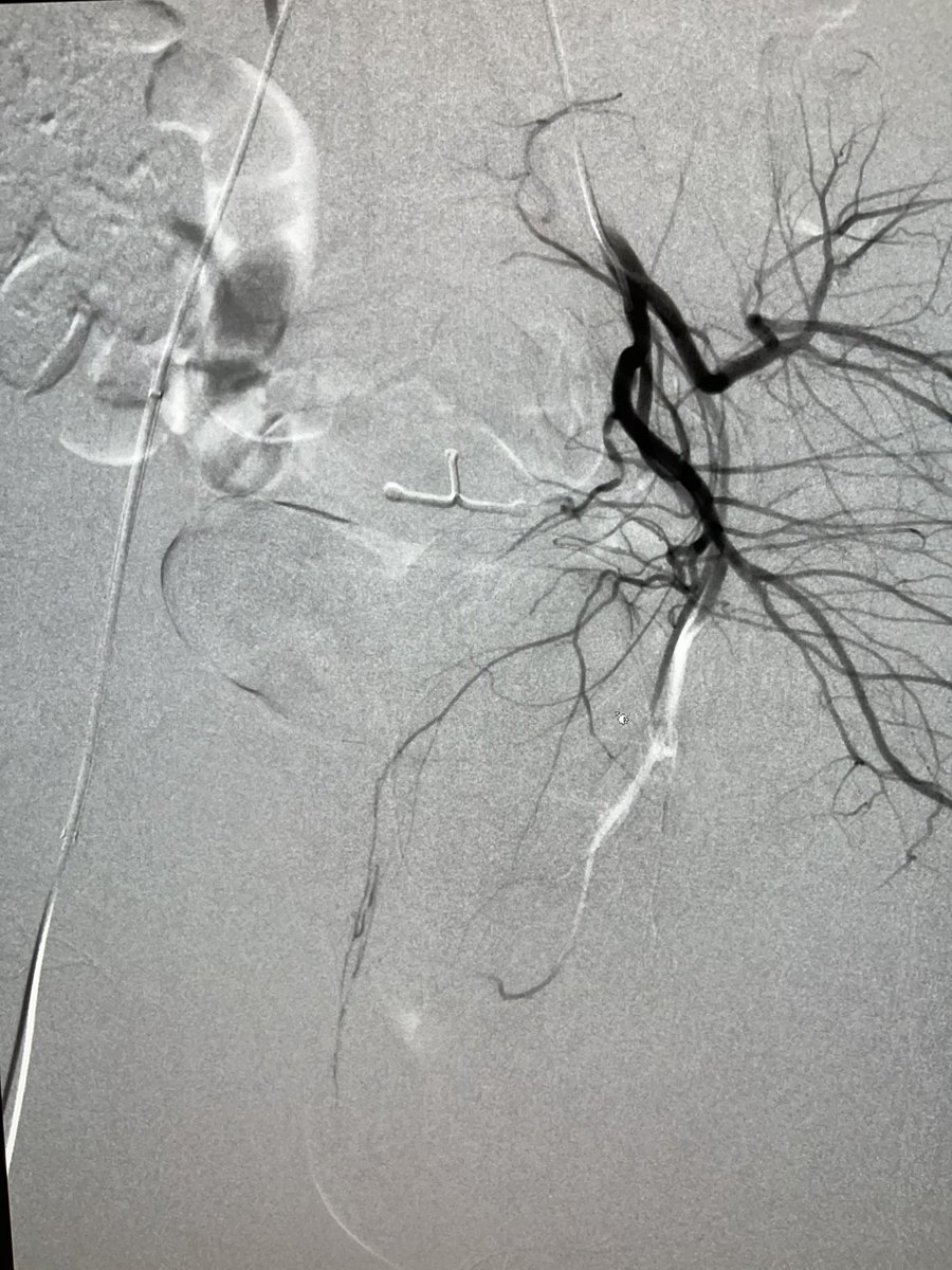 Ahmed Kamel MD, PhD, FSIR (@ahmed_kamel_ir) on Twitter photo Pelvic floor leiomyosarcoma, treated <a href="/UTHouston_IR/">UT Houston_IR</a> by bland #embolization prior to #excision to minimize intra and postoperative blood loss. Very selective embolization of the tumor while maintaining perfusion to the remaining pelvic organs and structures. Pelvic floor leiomyosarcoma, treated <a href="/UTHouston_IR/">UT Houston_IR</a> by bland #embolization prior to #excision to minimize intra and postoperative blood loss. Very selective embolization of the tumor while maintaining perfusion to the remaining pelvic organs and structures.