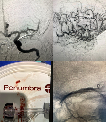 PenNeuro's tweet image. US HCPs: #RED68 impresses at @CHRISTUSTMF with Dr. Kurt Reuland. #RaisingTheStandard #REDglideDifference Rx only. For indications, contraindications, warnings, precautions &amp;amp; potential adverse events see bit.ly/2BYj7Yj Clinical results may vary.