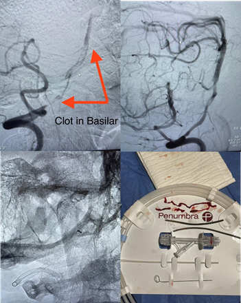PenNeuro's tweet image. US HCPs: Dr. Kurt Reuland with his first posterior stroke #RED68 case! #RaisingTheStandard #REDglideDifference Rx only. For indications, contraindications, warnings, precautions &amp;amp; potential adverse events see bit.ly/2BYj7Yj Clinical results may vary.