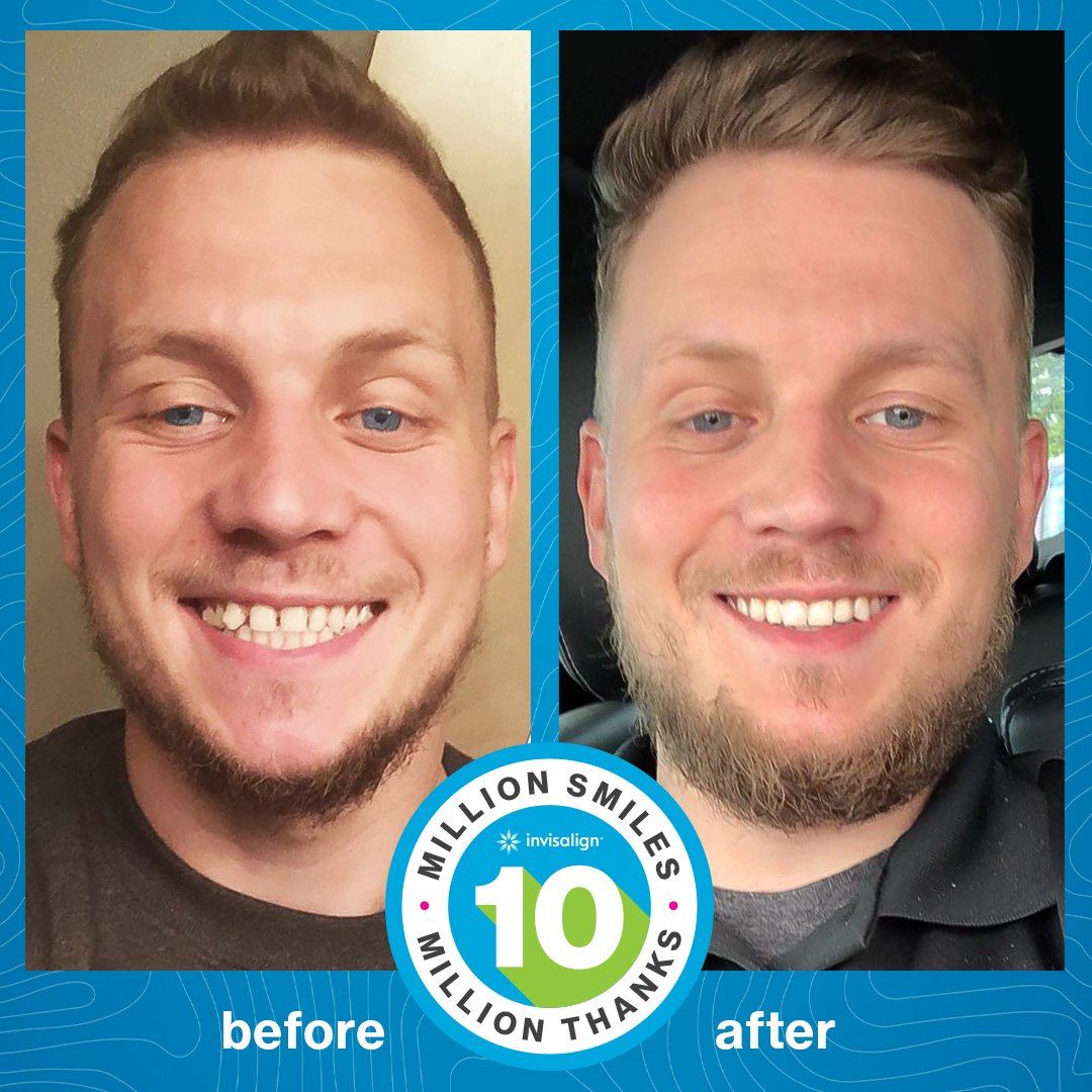 Invisalign's tweet image. Here’s an Invisalign® treatment result that will have you smiling. 😀👍

📸trevormills 

#invisalign #invisalignsmile #transformationtuesday