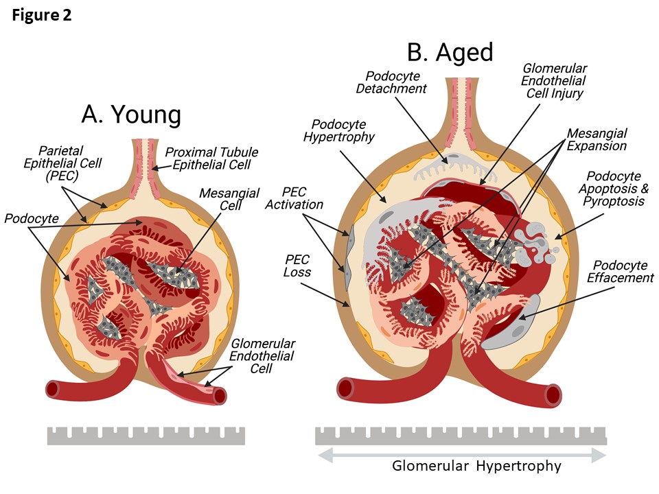 JASN_News's tweet photo. Age-associated changes to podocytes adversely affect kidney health. This Review discusses the molecular and cellular mechanisms underlying podocyte aging and approaches to mitigate progressive damage to podocytes https://t.co/jCzLKFtWao https://t.co/Afr8fAZkpl