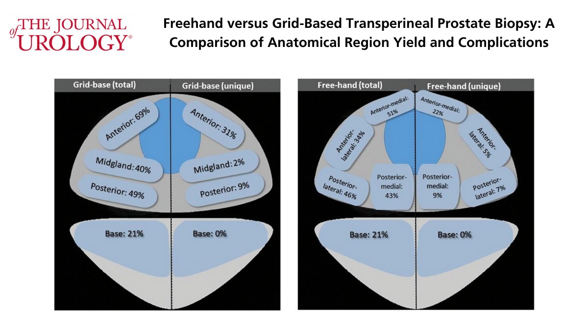JUrology's tweet photo. This comparison of free-hand vs grid-based transperineal prostate biopsy showed fewer complications, better efficiency, and less anesthesia.

Read the full text here: https://t.co/I7ZWCfSACN @jdhdavis https://t.co/1ajPtPVOQI
