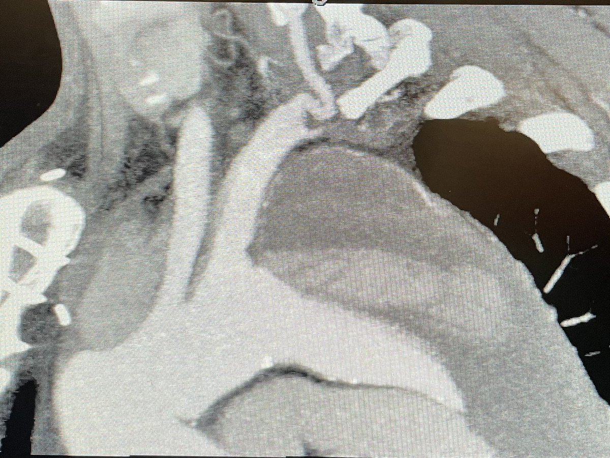 Ascending aortic tube graft can save lives in #aorticdissection but can also have significant complications in followup with few good options for repair. #AorticDissectionAwarenessWeek #aortaed #aortasupporta @ADCollab @AorticDissectUS