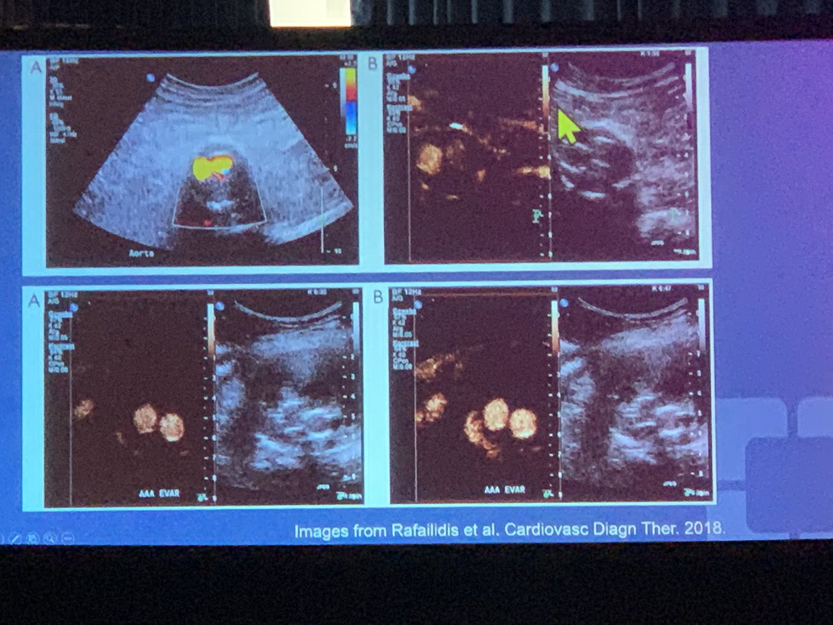 Jacobo Kirsch, MD, MBA, FACR (@kirschj) on Twitter photo Great talk on Contrast-Enhanced US of the Aorta by Sasan Partovi at #NASCI2021
<a href="/NASCISociety/">NASCI</a> <a href="/ClinicRadiology/">Cleveland Clinic Diagnostic Radiology Residents</a> <a href="/ClevelandClinic/">Cleveland Clinic</a> <a href="/CleClinicNews/">ClevelandClinicNews</a> <a href="/CleClinicMD/">Cleveland Clinic MD</a> <a href="/HeartVasc_CCFla/">CleClinicFlaHVI</a> Great talk on Contrast-Enhanced US of the Aorta by Sasan Partovi at #NASCI2021
<a href="/NASCISociety/">NASCI</a> <a href="/ClinicRadiology/">Cleveland Clinic Diagnostic Radiology Residents</a> <a href="/ClevelandClinic/">Cleveland Clinic</a> <a href="/CleClinicNews/">ClevelandClinicNews</a> <a href="/CleClinicMD/">Cleveland Clinic MD</a> <a href="/HeartVasc_CCFla/">CleClinicFlaHVI</a>