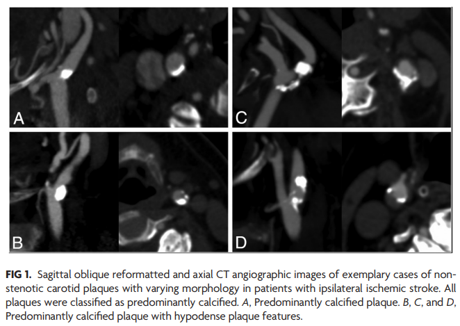 TheAJNR's tweet photo. "Nonstenotic Carotid Plaques in Ischemic Stroke: Analysis of the STRATIS Registry" |  #NeuroRad @mayank_G0 @nishita_singh3 @johanna_ospel | https://t.co/EZMEkdD19c https://t.co/quF8JHJ3Y2