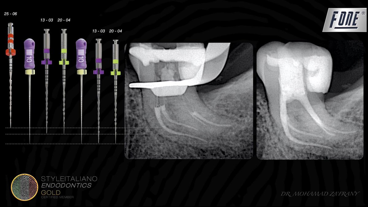 Mia75503607's tweet photo. A referred case of tooth no.36 with Symptomatic irreversible pulpitis
From preoperative radiograph severe curved root could be noticed.
Succefuly shaped using #AFFOne rotary files.
Thanks for Dr. Mohammed Za'frany sharing. https://t.co/TTgmrl1q0X