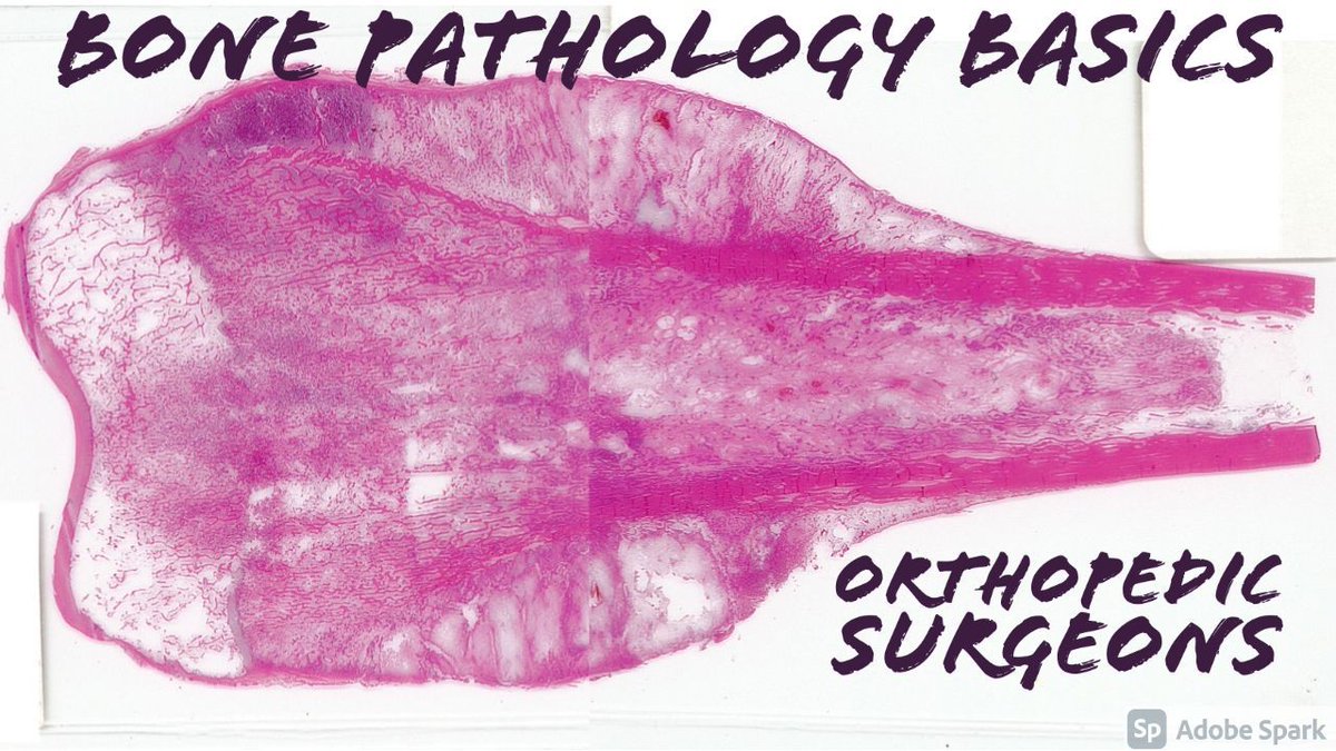 JMGardnerMD's tweet photo. Check out my Bone &amp; Soft Tissue Pathology for Beginners video: https://t.co/CXM2prPo5k. #pathologists #pathology #pathTwitter #orthotwitter #ortho #BSTpath #medtwitter #medstudenttwitter #usmle https://t.co/3FKHox9Jj2