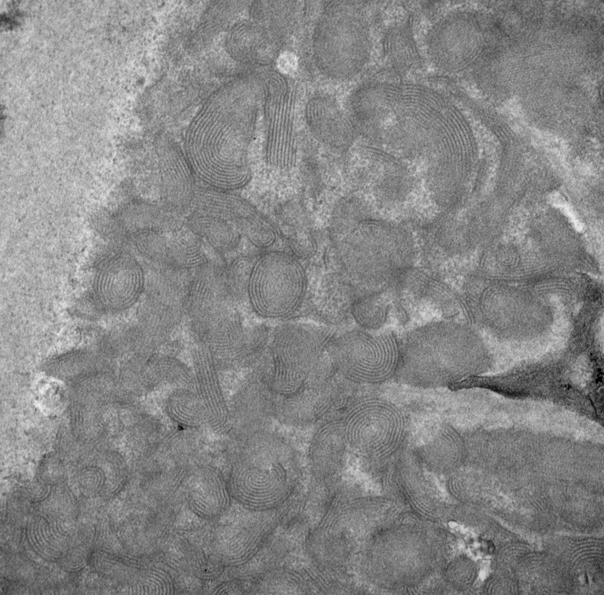 JeanHouMD's tweet photo. Touched by lupus: I don't know why some deposits seem to organize into these "fingerprint" structures more than others, but I've seen them in all stages and all locations... And the saying holds true, even for gloms: No one's fingerprints are exactly the same as anyone else's! https://t.co/atKZtEPzyH
