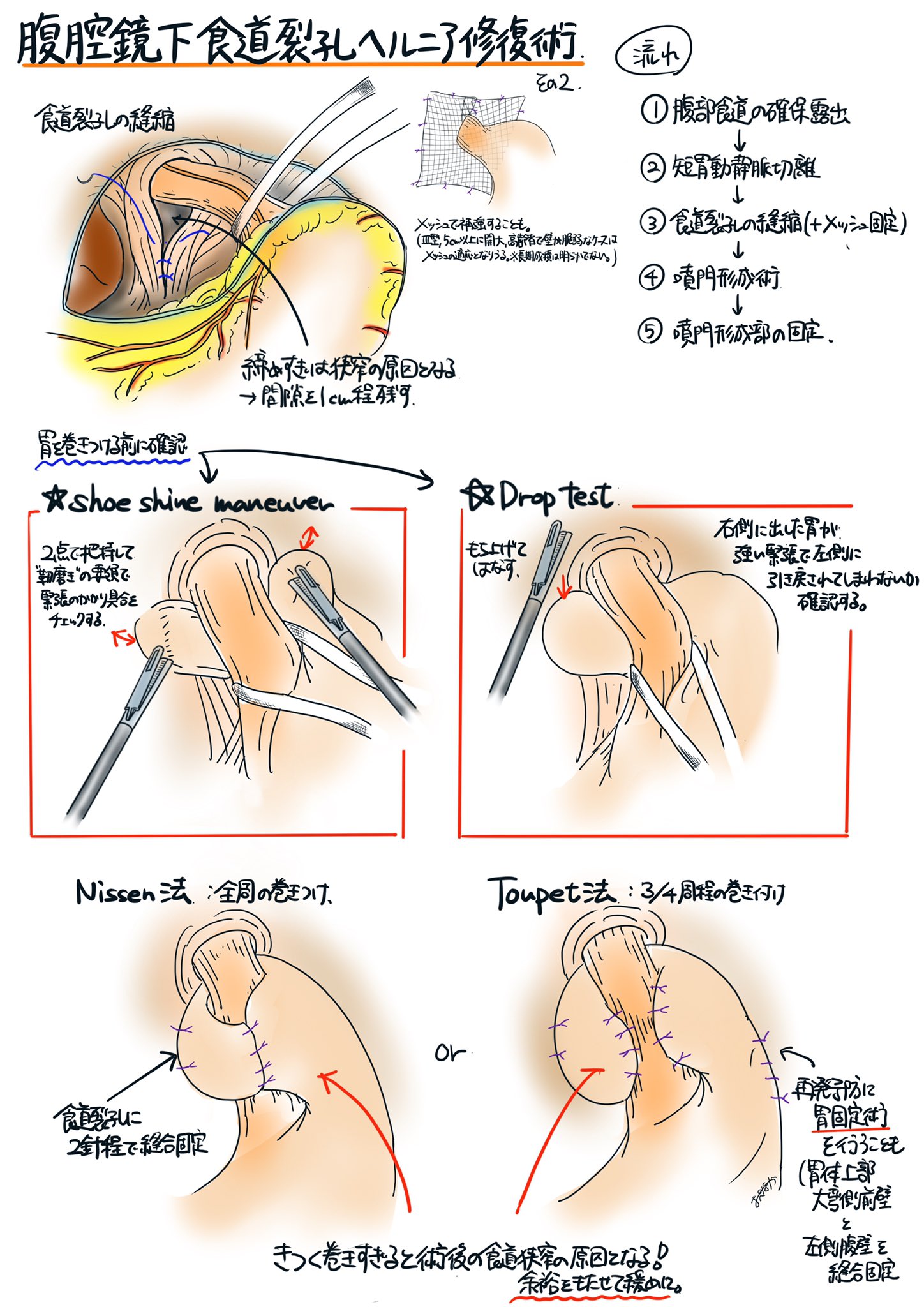 おぺなか 腹腔鏡下食道裂孔ヘルニア修復術 その2 食道裂孔縫縮 噴門形成 食道狭窄を防ぐためにshoe Shine Maneuver 靴磨き法 とdrop Testで締め付け具合を確認してから噴門形成します 巻き付けは緩めがいいみたいですね 前回から間が空いてすみませんで